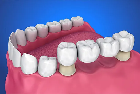 Model tooth and implant supported dental crown