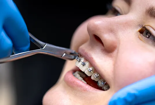 Benefits of Orthodontic Treatment