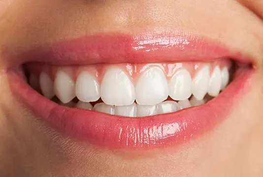Benefits of Teeth Whitening