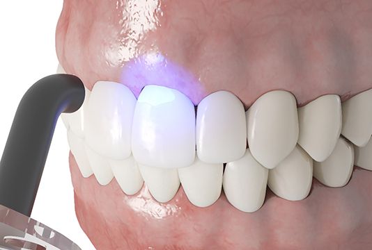 Illustration of dental bonding in Raleigh, NC