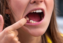 Woman showing a missing tooth
