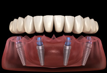 Digital image of an implant denture