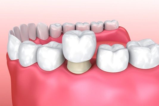 dental crown