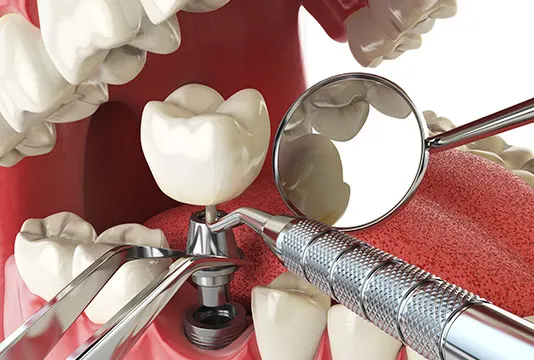 Our Dental Implant Process (Step-By-Step Guide