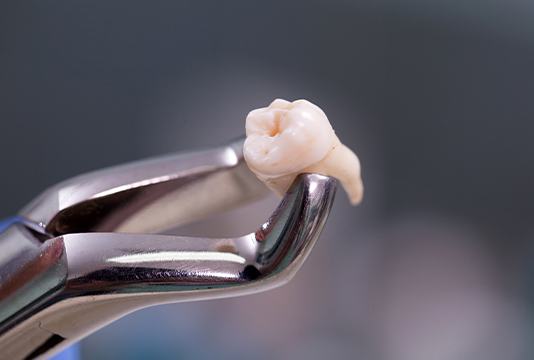 Metal clasp holding extracted tooth