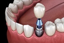 Animation of implant supported dental crown process