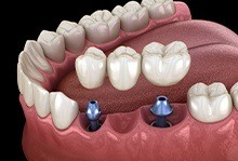 Animation of implant supported fixed bridge process