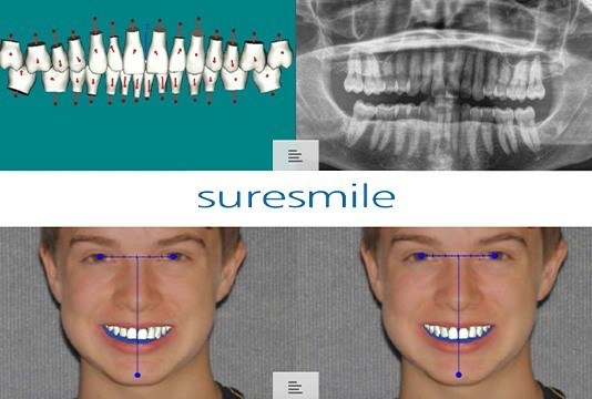 Smile alignment plan on computer