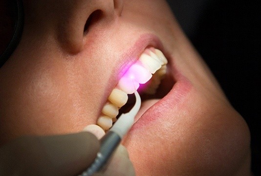 Dental laser