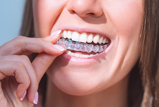 A person inserting SureSmile