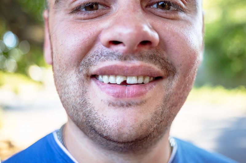 Man with chipped tooth