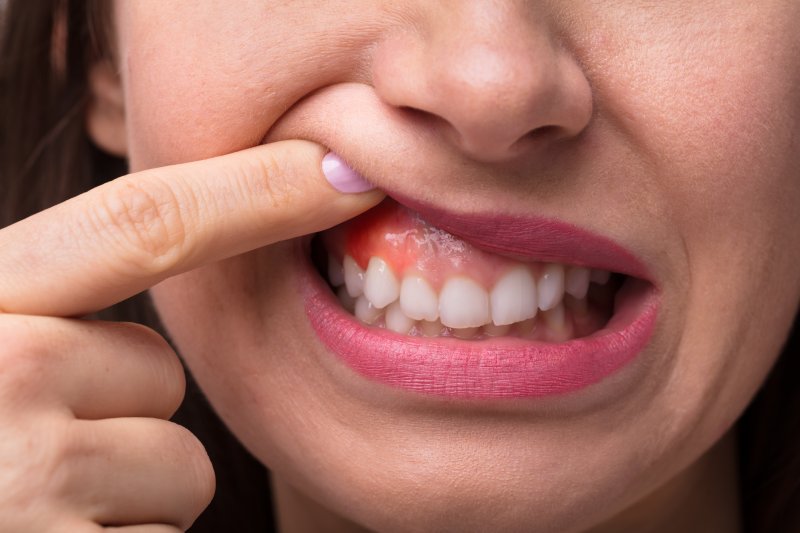 woman showing her sore gums