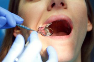a dentist examining a patient’s mouth for a cavity