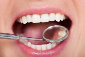 What Are the Signs That You Need a Dental Filling?