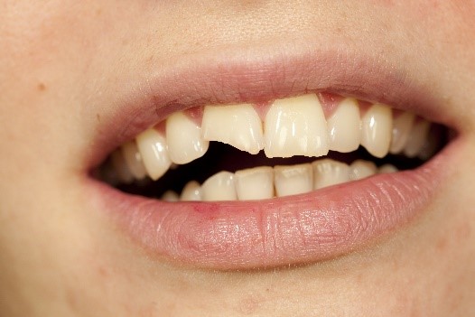 A chipped tooth