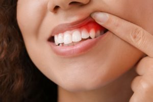 A closeup of a woman with gum disease
