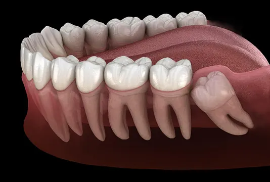 Benefits of Early Wisdom Tooth Removal