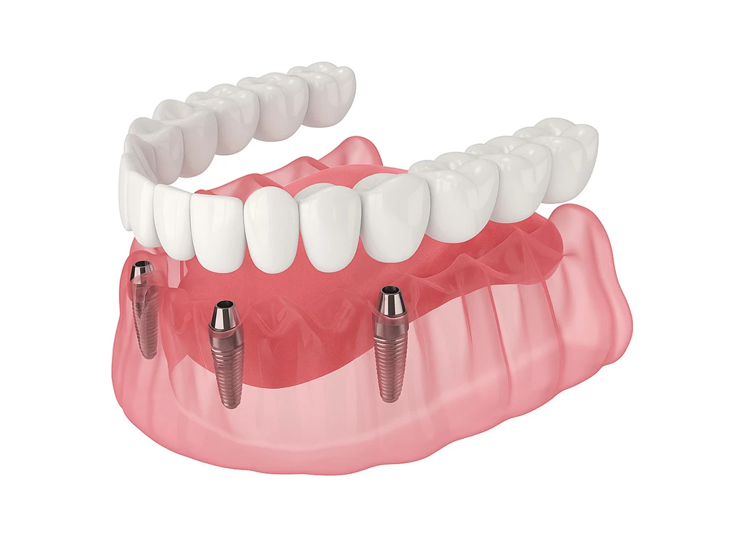 Missing All of Your Teeth