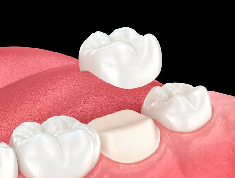 Dental Crowns