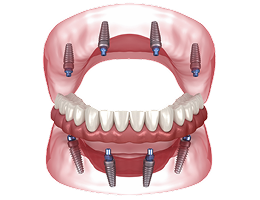 Permanent PMMA Teeth Single Arch