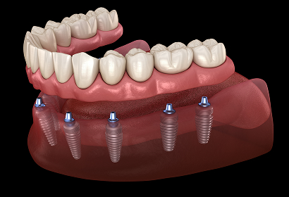 Full Arch Solutions & Implant-Supported Dentures
