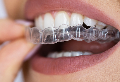 Clear Aligner Therapy