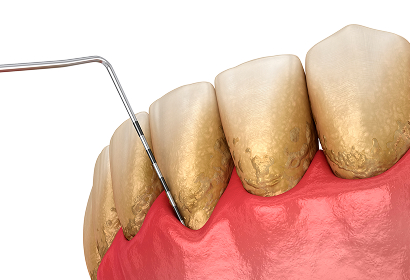 Periodontal Evaluation & Maintenance