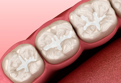 Tooth-Colored Fillings