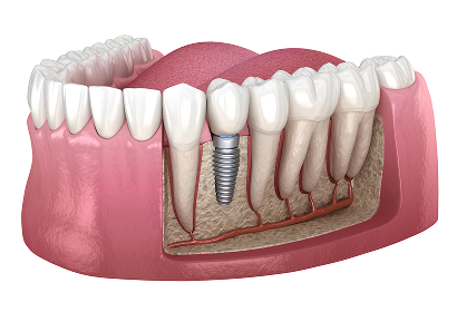 Single Dental Implant (Placement + Restoration)