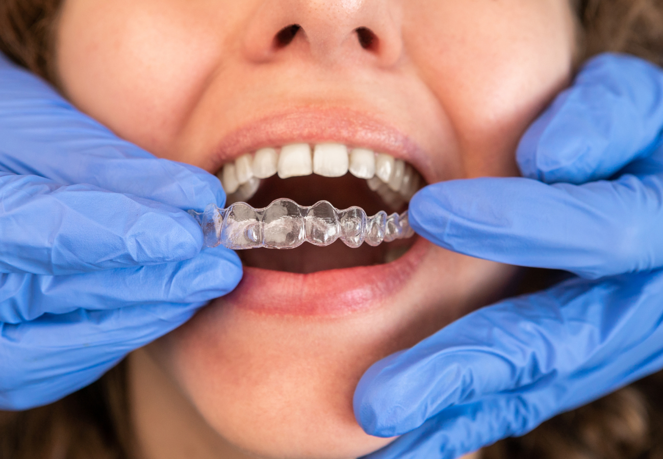 Smiling woman placing Invisalign aligner on top teeth