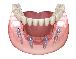 Permanent Zirconia Teeth Single Arch