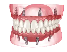 Permanent Zirconia Teeth Double Arch